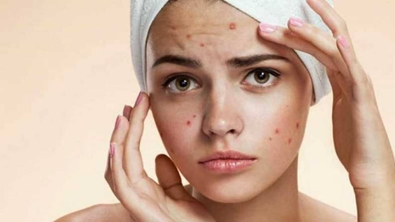 ব্রণর সমস্যায় ভুগছেন? জেনে নিন ব্রণ হওয়ার পাঁচটি কারণ