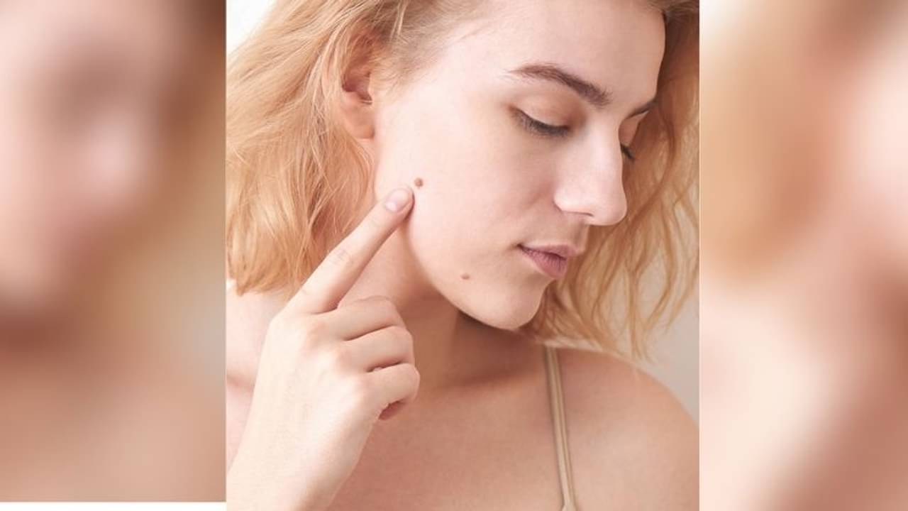 অবাঞ্ছিত তিল দূর করবেন কীভাবে? জেনে নিন সহজ উপায়