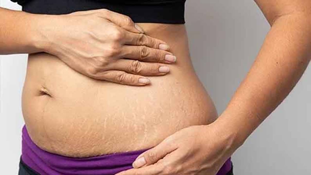 স্ট্রেচ মার্ক: কেন দেখা দেয় এই দাগ-ছোপ, কীভাবে কমাবেন সমস্যা?