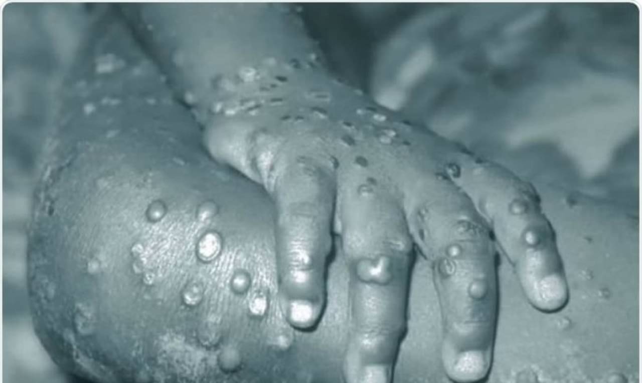 মাঙ্কিপক্স কী? এই বিরল রোগে আক্রান্তদের নিয়ে উদ্বেগ শুরু বিশেষজ্ঞমহলে