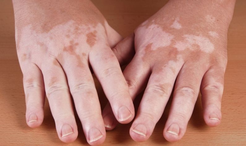 World Vitiligo Day 2021: শ্বেতী হলে কোন কোন খাবার থেকে দূরে থাকা উচিত, জেনে নিন