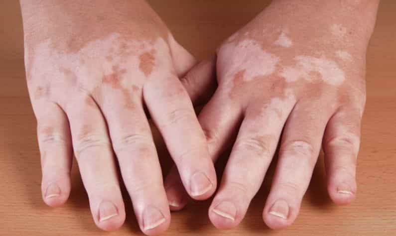 World Vitiligo Day 2021: শ্বেতী হলে কোন কোন খাবার থেকে দূরে থাকা উচিত, জেনে নিন World Vitiligo Day 2021: শ্বেতী হলে কোন কোন খাবার থেকে দূরে থাকা উচিত, জেনে নিন
