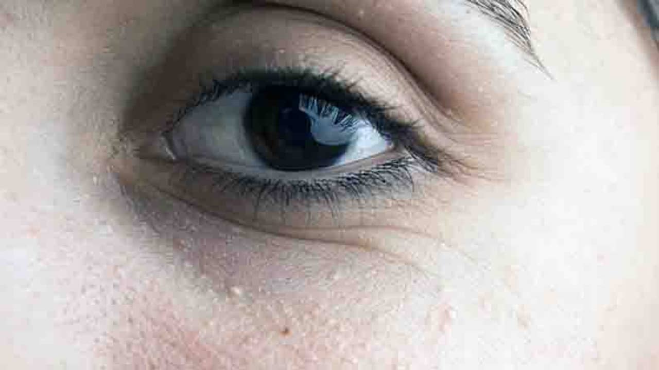 ঘরোয়া টোটকা মেনে দূর করুন চোখের তলার কালচে ভাব