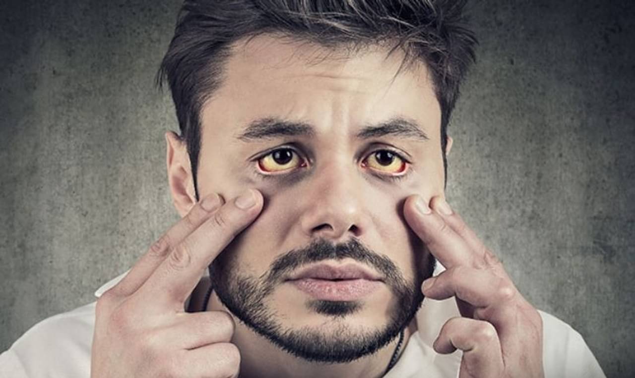 জন্ডিসের লক্ষণ দেখলে হেলাফেলা নয়! এই ৫ ঘরোয়া টোটকায় দ্রুত সারবে লিভারের রোগ