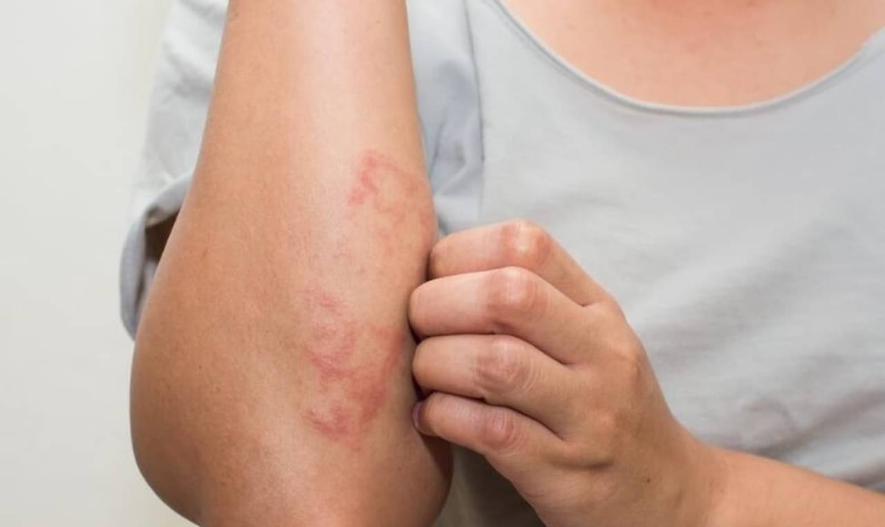 ত্বকে কি খুব র‍্যাশ বের হয়? রইল সেরা ৪ ভেষজ উপায়