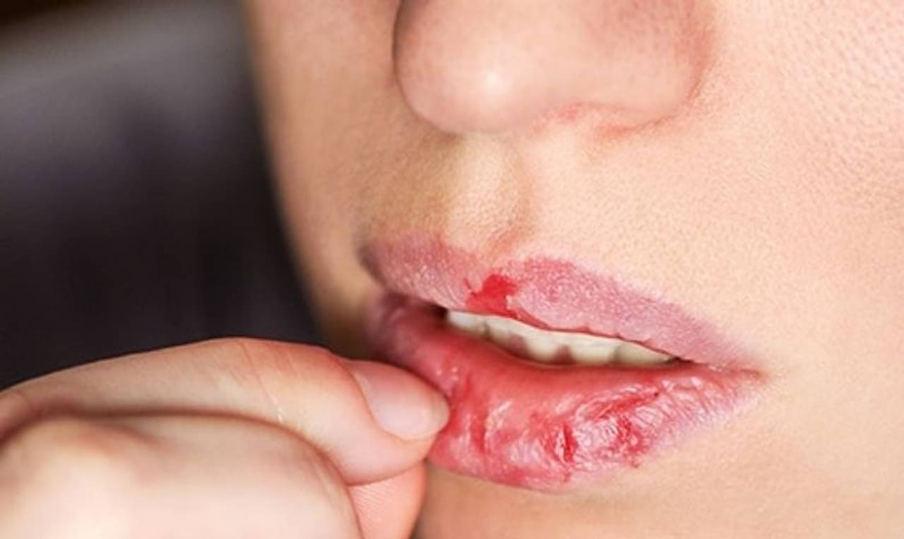 গরমেও ঠোঁট ফাটে! নরম ও সুন্দর ঠোঁটের জন্য নারকেল তেলের লিপ-বাম অব্যর্থ টোটকা