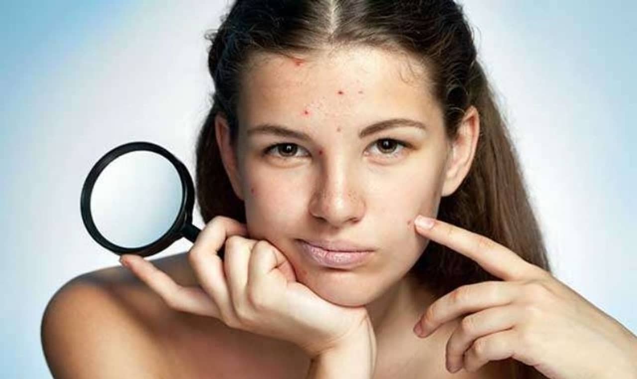 ত্বকে কালচে দাগ ও হাইপারপিগমেন্টেশনের সমস্যা! এক সপ্তাহেই বলুন গুডবাই