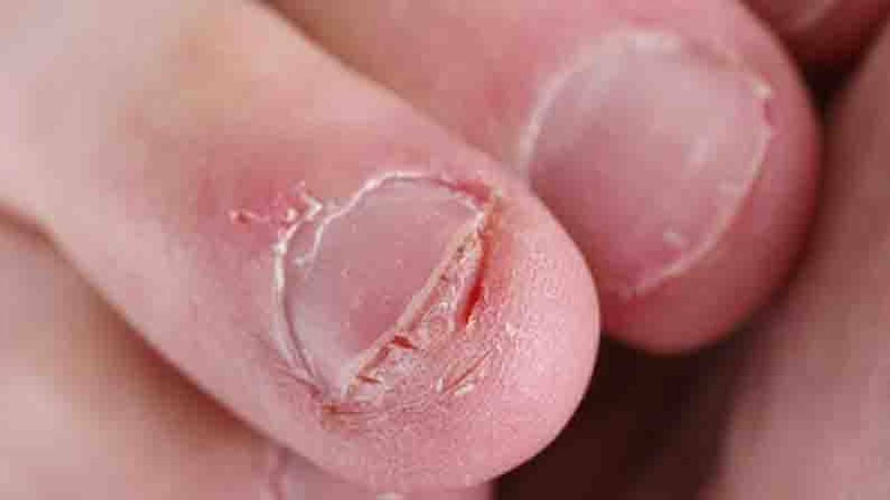 কতখানি সুস্থ আছেন আপনি? বলবে আপনার নখ