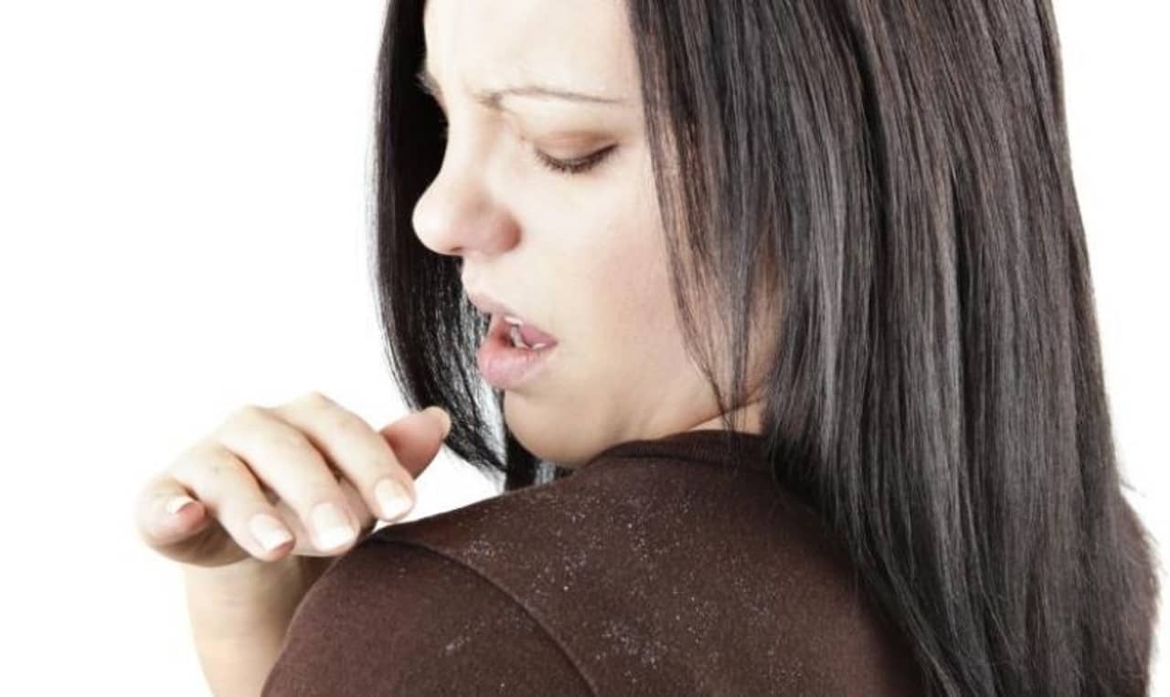 Monsoon Hair Care: বর্ষায় খুশকিকে গুডবাই জানাতে এই দুরন্ত ঘরোয়া টোটকা মোক্ষম দাওয়াই!