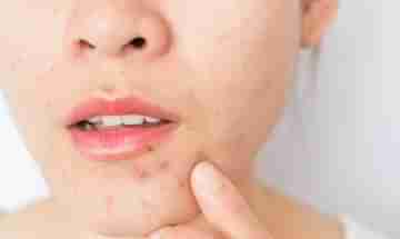 Tips to Prevent Acne: দিনে ২ লিটারেরও কম জল পান করেন? ব্রণ থেকে মুক্তি পেতে রইল কিছু ম্যাজিক টিপস!