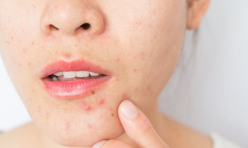 Tips to Prevent Acne: দিনে ২ লিটারেরও কম জল পান করেন? ব্রণ থেকে মুক্তি পেতে রইল কিছু 'ম্যাজিক' টিপস!