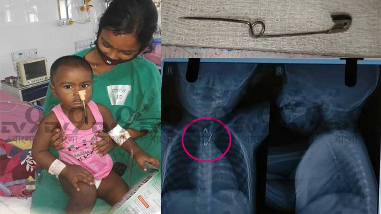এক বছরের শিশু গিলে ফেলল সেফটি পিন, যন্ত্রণায় যতই ছটফট করছে ততই তা নামছে নিচের দিকে...