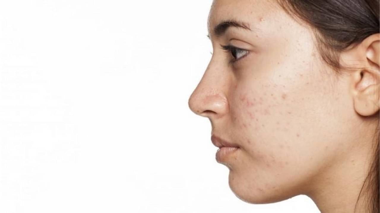 Adult Acne: প্রাপ্তবয়স্কদের মধ্যেও ব্রণর সমস্যা কেন দেখা যায় জানেন?