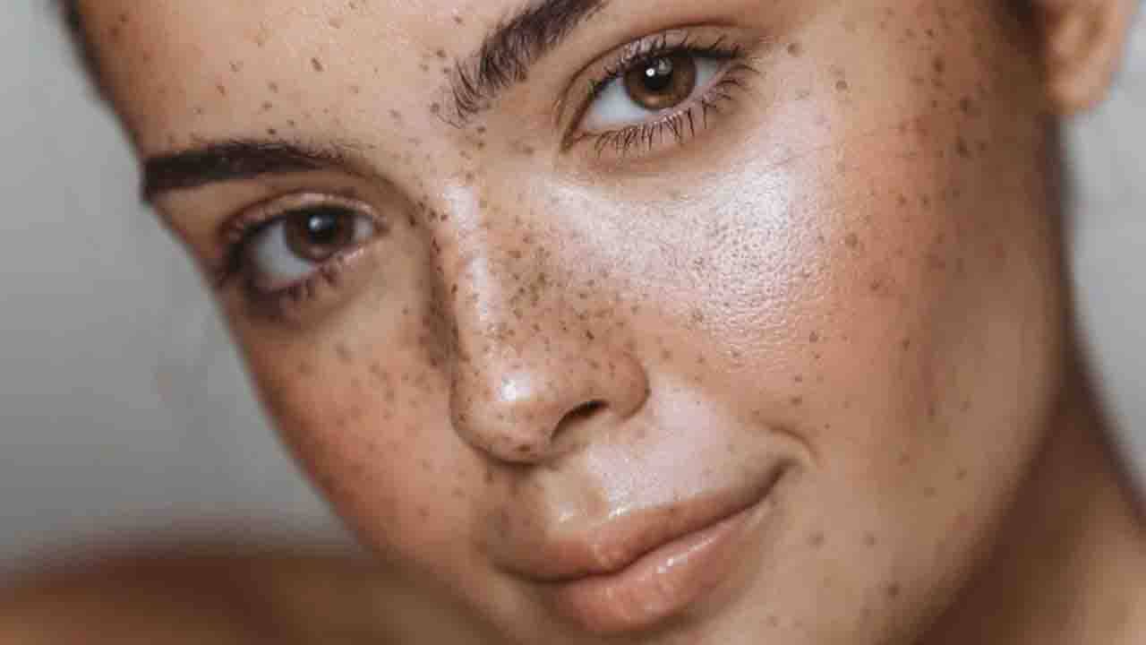 Hyperpigmentation: হাইপারপিগমেনটেশন মানেই কি শুধু ট্যান? জানুন এর আসল কারণগুলি কী কী