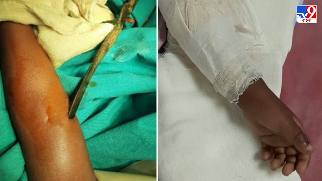 এনআরএস-এ জটিল অস্ত্রোপচার, তিন বছরের শিশুর হাত থেকে বের করা হল কাস্তের ফলা!