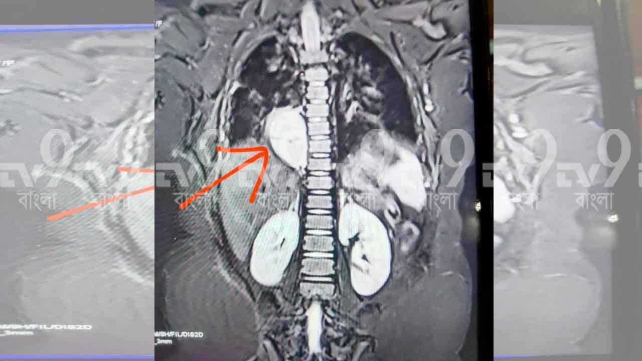 Rohhad Net: নিজের জিভও ছিঁড়ে খেয়ে ফেলছিল ৫ বছরের শিশু! অস্ত্রোপচারে সরল টিউমার, শুধু মিরাকলের অপেক্ষা