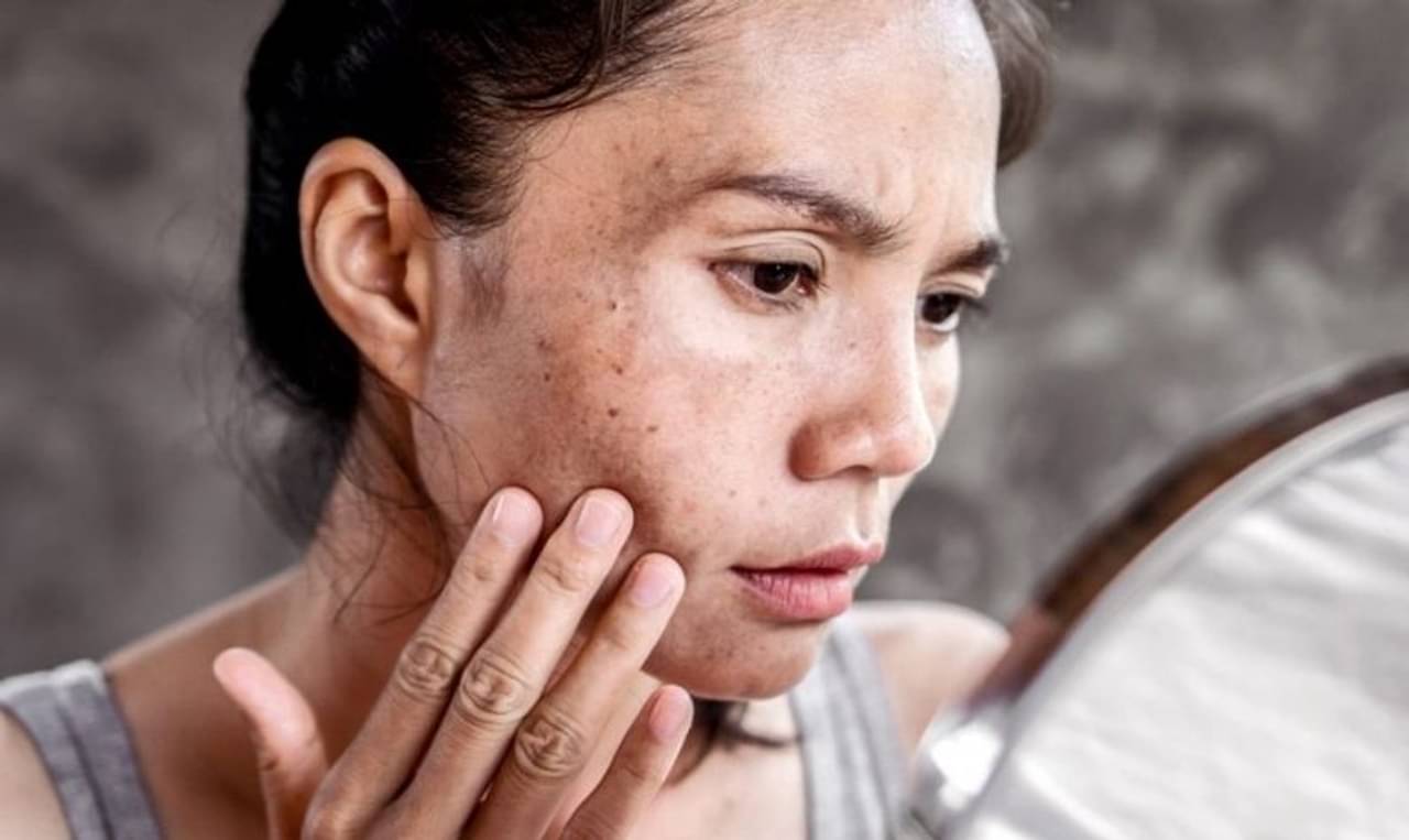ত্বকের পুড়ে যাওয়া কালো দাগ আর লুকোতে হবে না! এবার ঘরোয়া ফেসপ্যাকেই হবে মির‍্যাকল