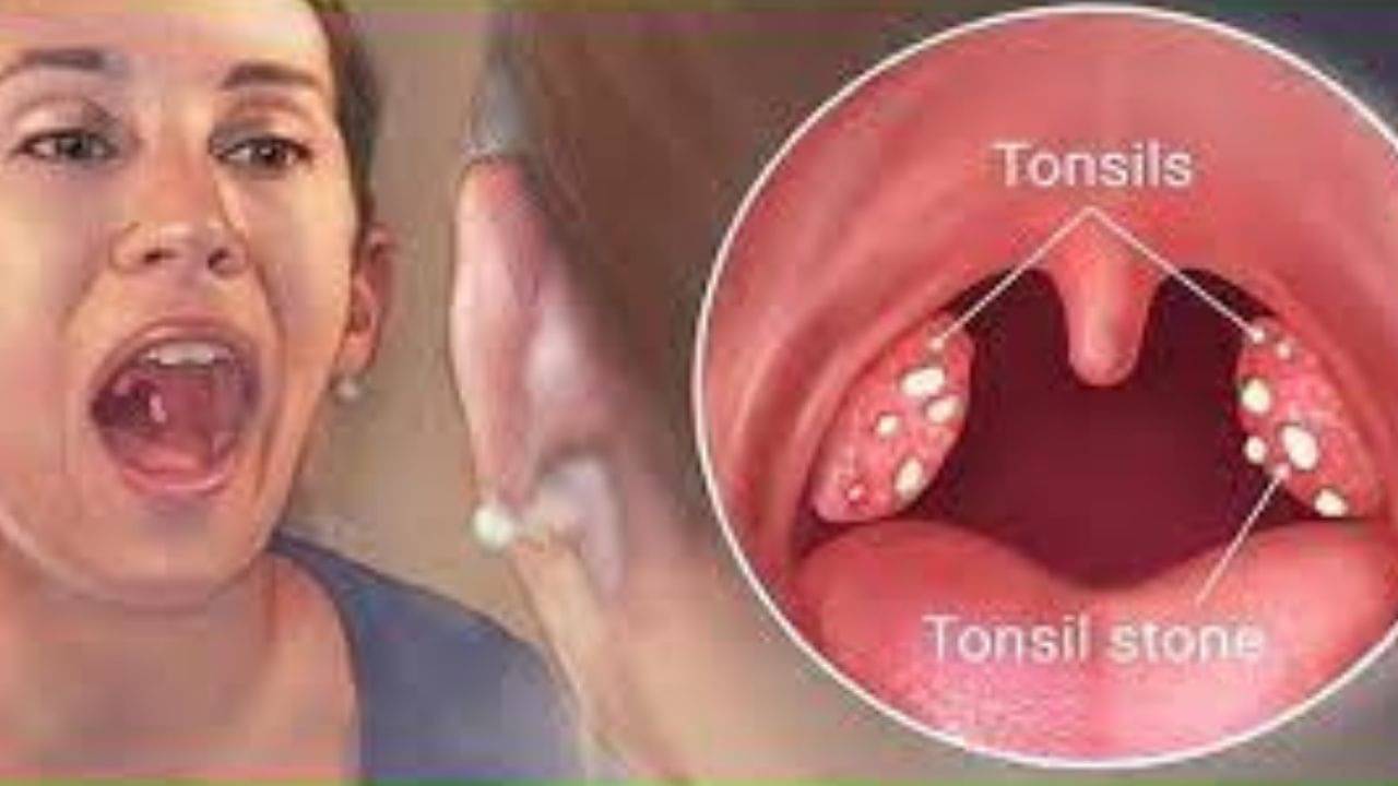 Tonsil Stone: দীর্ঘদিন ধরে টনসিলে ব্যাথা অনুভব করছেন! সহজ ঘরোয়া উপায়েই গলবে টনসিলের স্টোন