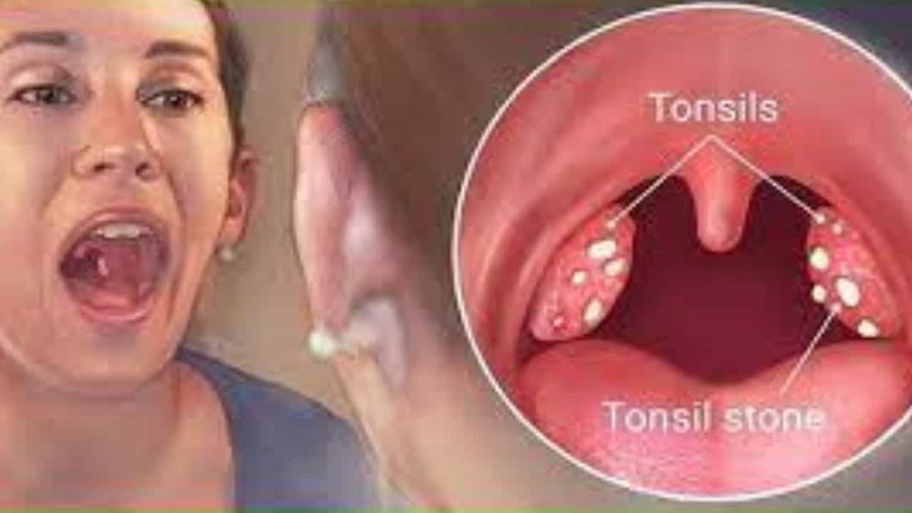Tonsil Stone: দীর্ঘদিন ধরে টনসিলে ব্যাথা অনুভব করছেন! সহজ ঘরোয়া উপায়েই গলবে 'টনসিলের স্টোন' Tonsil Stone: দীর্ঘদিন ধরে টনসিলে ব্যাথা অনুভব করছেন! সহজ ঘরোয়া উপায়েই গলবে 'টনসিলের স্টোন'