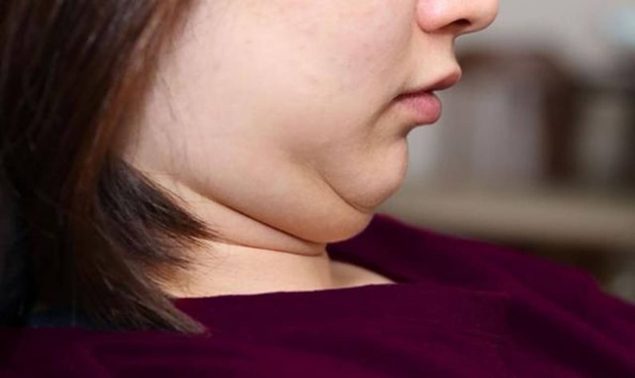 Double Chin: ডবল চিন নিয়ে অস্বস্তি? মুখের অতিরিক্ত মেদ ঝরাতে এই সহজ ব্য়ায়ামগুলি প্রতিদিন করলেই মিলবে ফল!