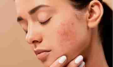 Hormonal Acne: হরমোনের তারতম্যে ব্রণর সমস্যায় জেরবার! মুক্তির উপায় কী, বলছেন বিশেষজ্ঞরা