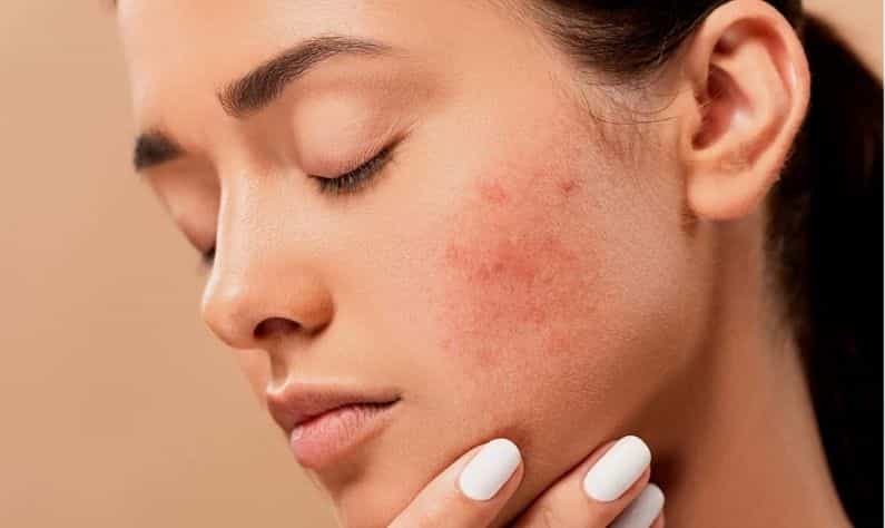 Hormonal Acne: হরমোনের তারতম্যে ব্রণর সমস্যায় জেরবার! মুক্তির উপায় কী, বলছেন বিশেষজ্ঞরা Hormonal Acne: হরমোনের তারতম্যে ব্রণর সমস্যায় জেরবার! মুক্তির উপায় কী, বলছেন বিশেষজ্ঞরা