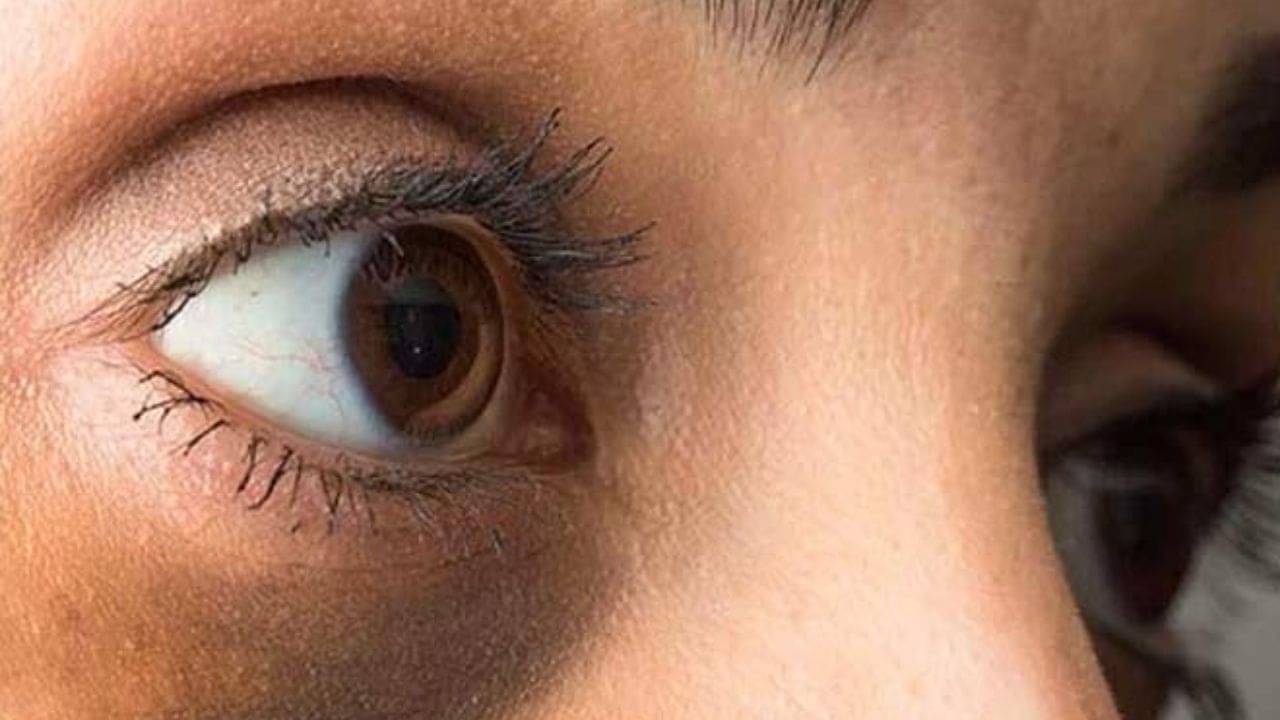 Dark Circles Care: খুব সহজে এবং প্রাকৃতিক উপায়ে এবার বাড়িতে বসেই ডার্ক সার্কেলের চিকিৎসা করুন