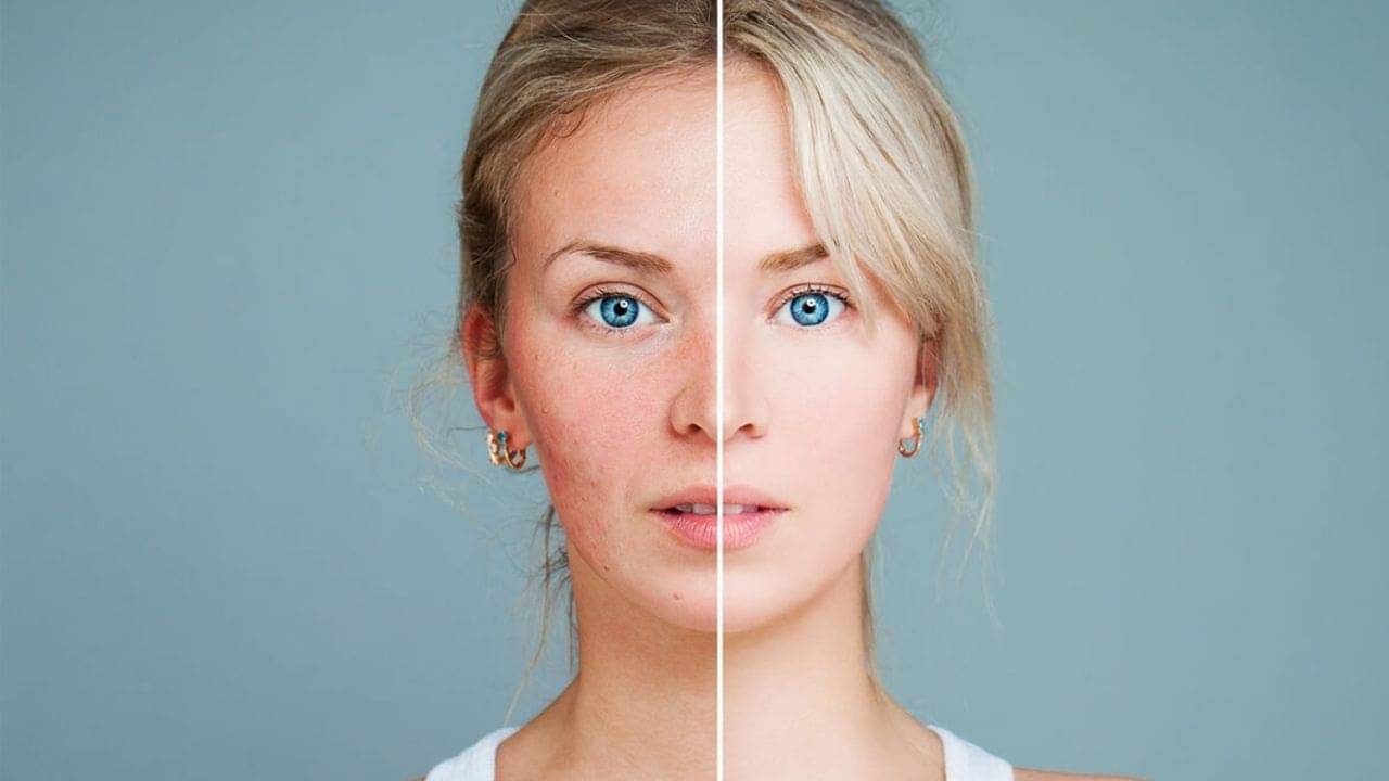 Skin Care Tips: মুখের লাল ভাবের কারণ আর সেগুলো নিরাময়ের উপায় জেনে নিন...