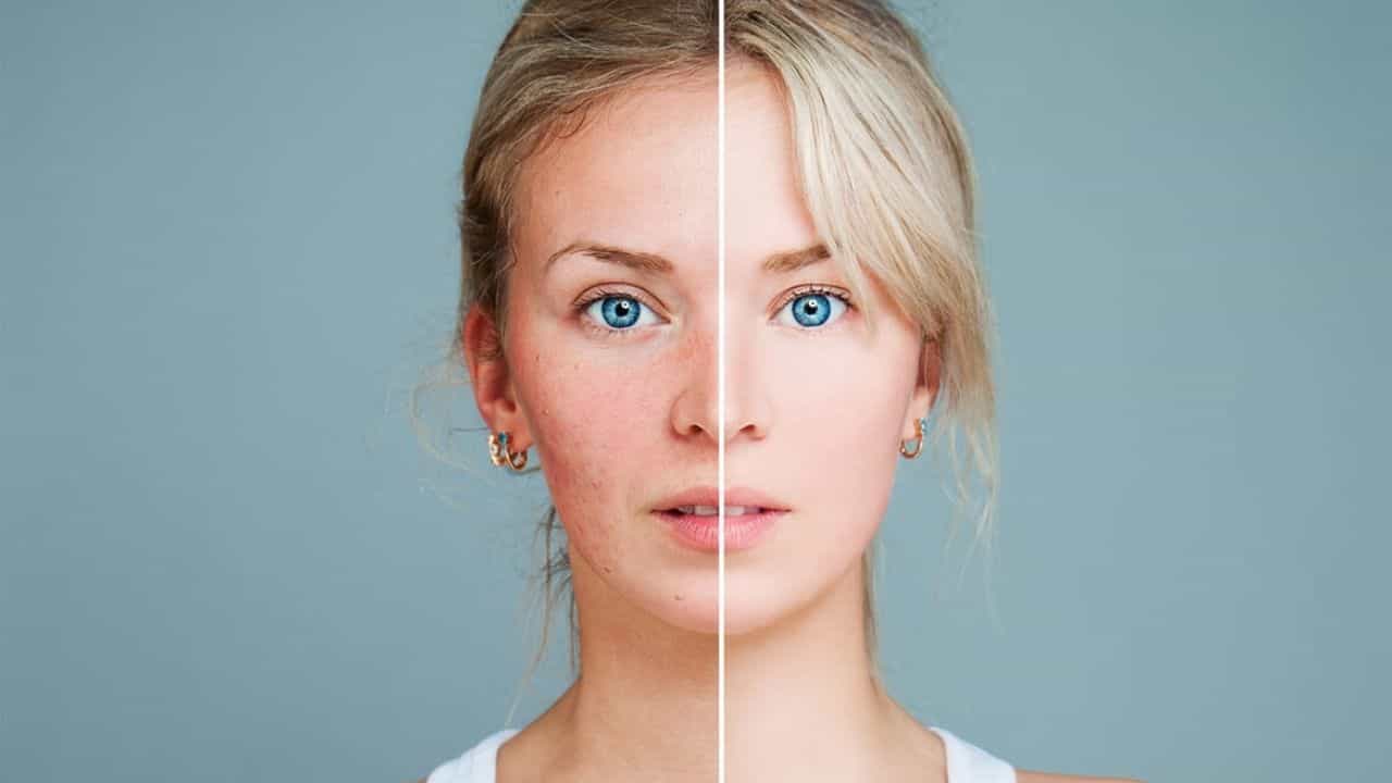 Skin Care Tips: মুখের লাল ভাবের কারণ আর সেগুলো নিরাময়ের উপায় জেনে নিন... Skin Care Tips: মুখের লাল ভাবের কারণ আর সেগুলো নিরাময়ের উপায় জেনে নিন...