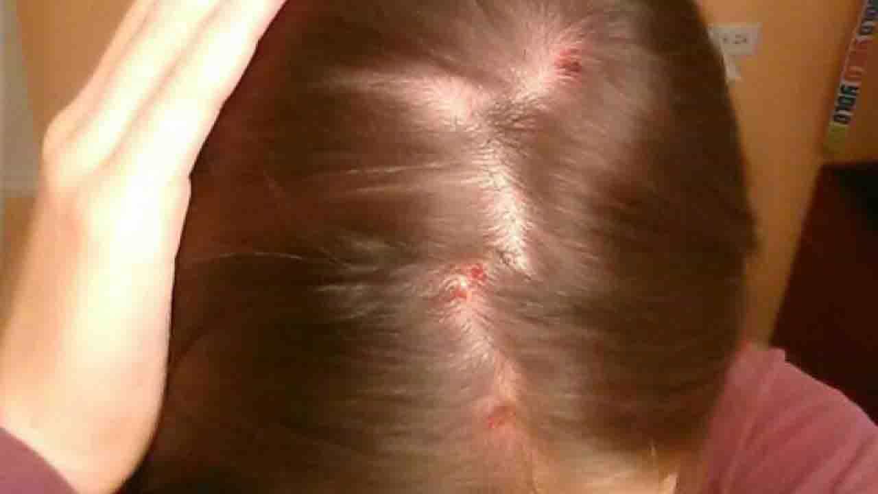 Scalp Acne: বর্ষায় মাথার ত্বকেও ব্রণ হচ্ছে? এই সমস্যা রেহাই পান ঘরোয়া উপায়ে! Scalp Acne: বর্ষায় মাথার ত্বকেও ব্রণ হচ্ছে? এই সমস্যা রেহাই পান ঘরোয়া উপায়ে!