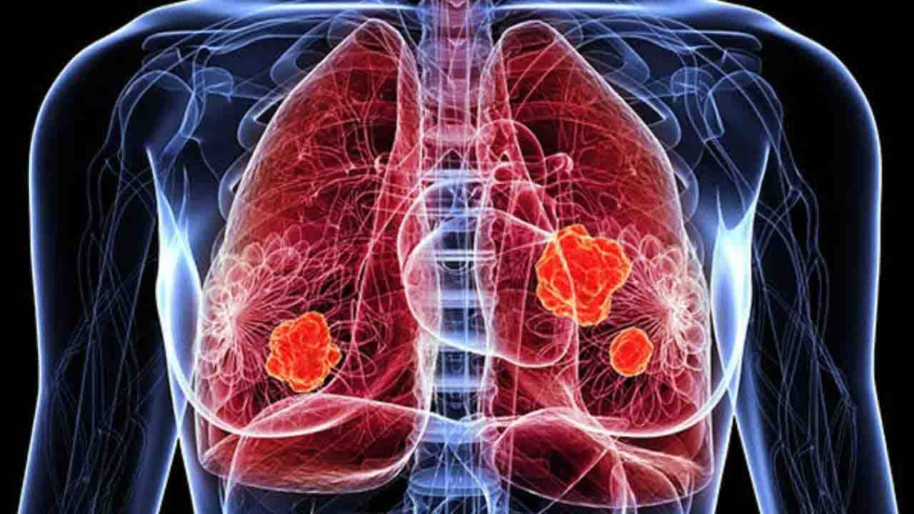 Lung Cancer: ধূমপান করেন না? তাতেও আপনার ফুসফুসে বাসা বাঁধতে পারে ক্যান্সার!
