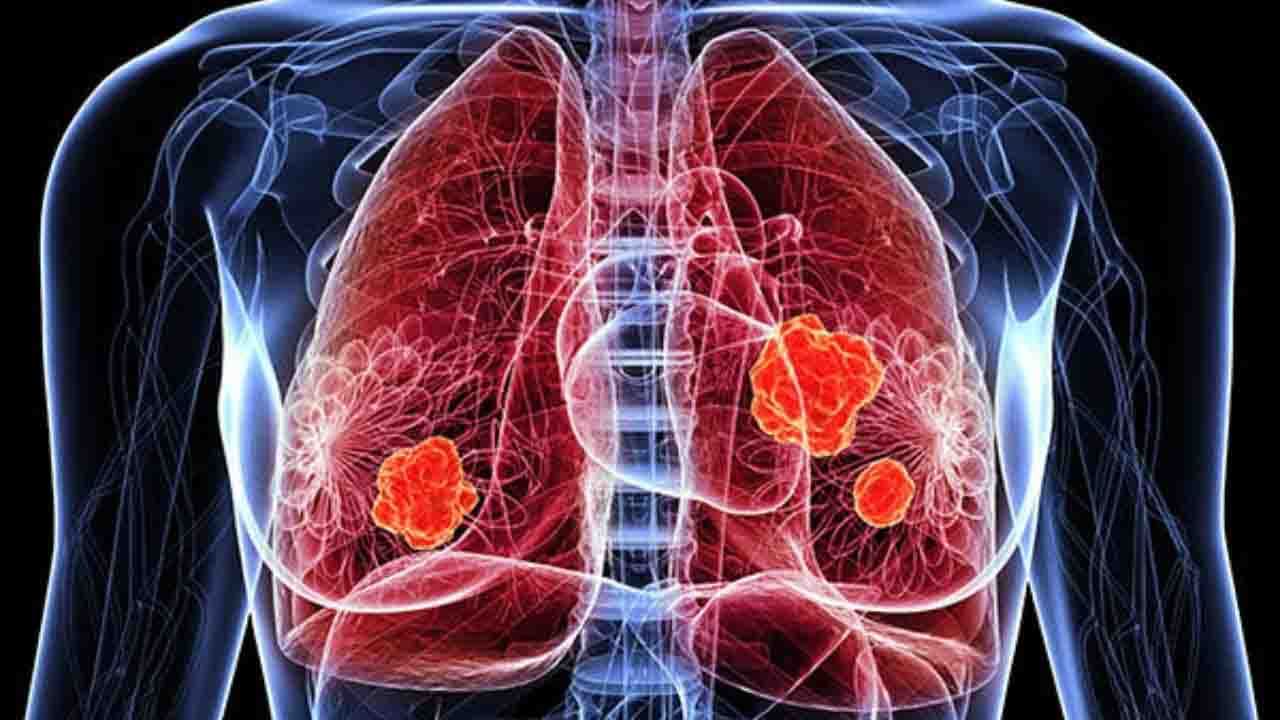 Lung Cancer: ধূমপান করেন না? তাতেও আপনার ফুসফুসে বাসা বাঁধতে পারে ক্যান্সার!