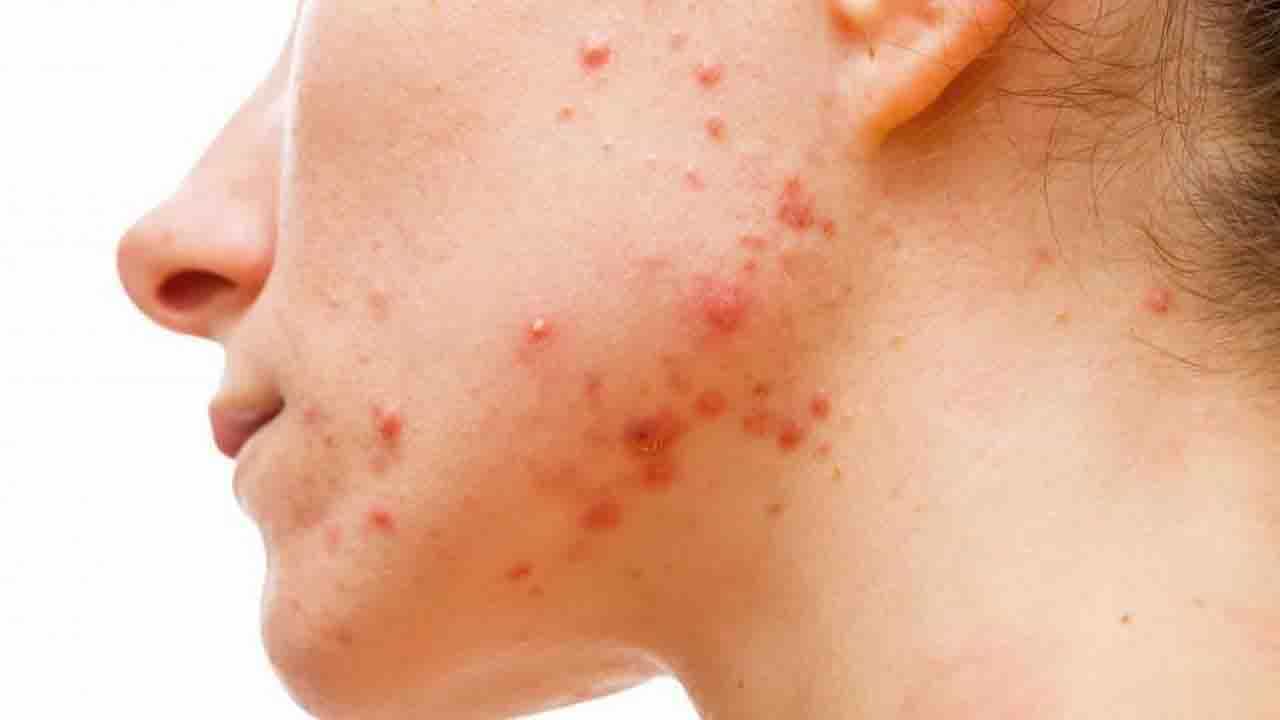 Pimple Marks Cure: বয়ঃসন্ধিকালে হওয়া ব্রণর দাগের হাত থেকে রেহাই পান ঘরোয়া উপায়ে! Pimple Marks Cure: বয়ঃসন্ধিকালে হওয়া ব্রণর দাগের হাত থেকে রেহাই পান ঘরোয়া উপায়ে!