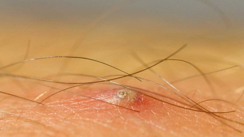 Ingrown Hair Removal