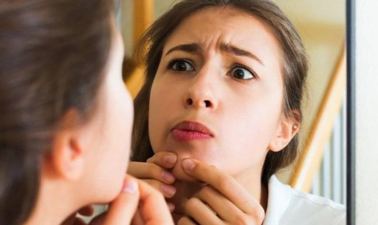 Pimple: ব্রণ খুঁটে ফেলার অভ্যেস রয়েছে? এক মিনিটের মধ্যে জ্বালাভাব কমান এই সহজ উপায়ে!