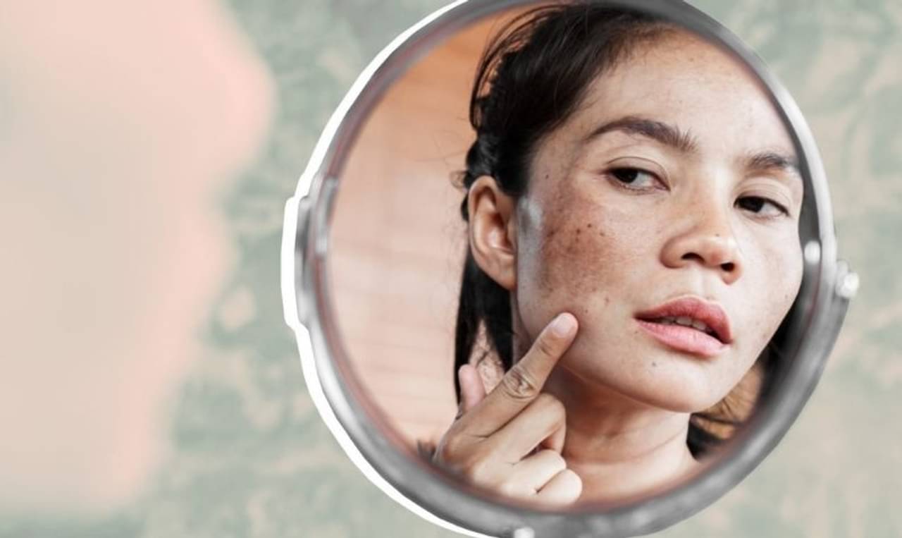 Dark Patches: ত্বকের উপর থেকে কালো দাগ হঠাবেন কীভাবে, তা নিয়ে দুশ্চিন্তার শেষ নেই! রইল কিছু জরুরি বিউটি টিপস