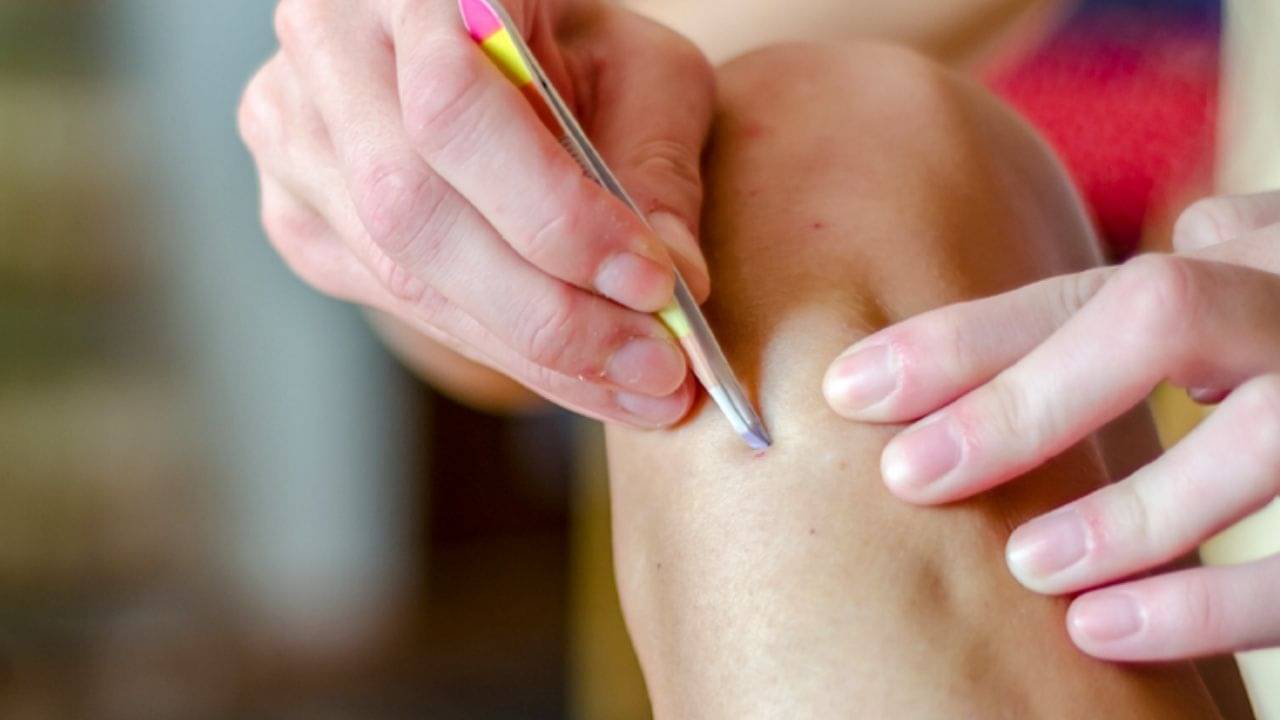 Ingrown Hair Removal: ত্বকের ইনগ্রোন চুল বিভিন্ন ধরনের সমস্যার সৃষ্টি করে, এই সমস্যা থেকে নিরাময়ের উপায়গুলো জেনে নিন...