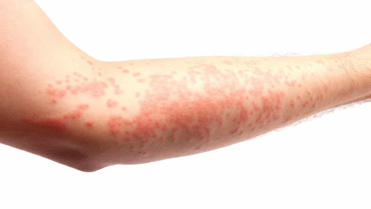 Alaw Rashes Skin Care: ত্বকের লাল হয়ে ফুলে যাওয়া আমবাতের কারণে হচ্ছে না তো? এই ...