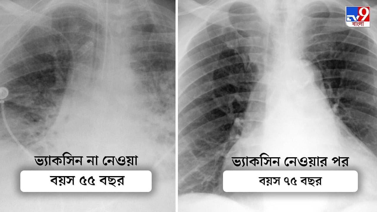 Covid Vaccine: এই এক্স রে ভালো করে দেখুন! সিদ্ধান্ত আপনার হাতে