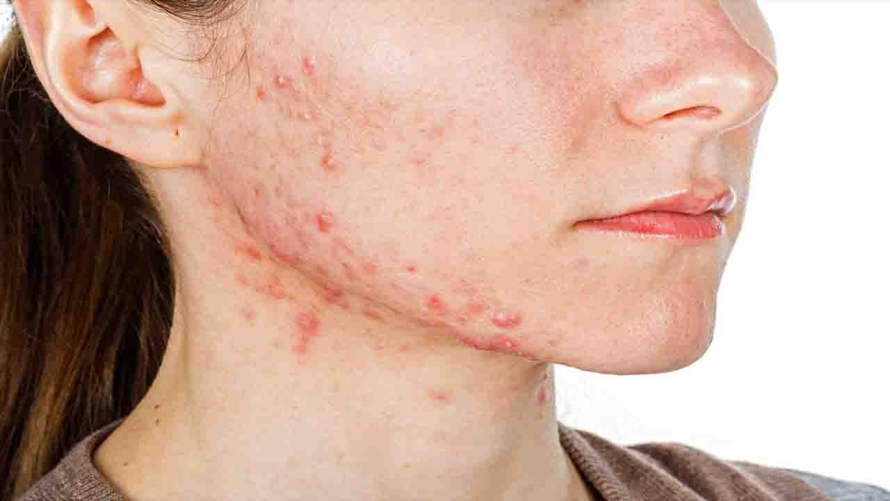 Premenstrual Acne: শুধুমাত্র পিরিয়ড শুরুর আগে ব্রণর সমস্যা দেখা দেয়? জানুন এর আসল কারণ কী