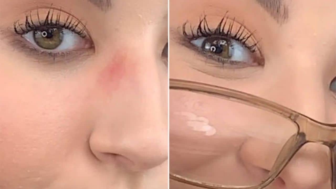 Spectacle Marks: সব সময় চশমা পরে থাকলে নাকের দুপাশে দীর্ঘস্থায়ী দাগ পড়ে যায়, এর থেকে নিরাময়ের উপায়গুলি জেনে নিন...