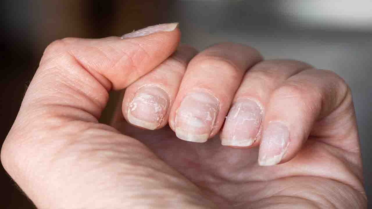 Nails Your nails can tell if you have cancer! Know how the color of