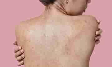 Back Acne: ব্যাকনে কী? এই সমস্যা থেকে মুক্তি পেতে রইল কিছু সেরা ঘরোয়া উপায়