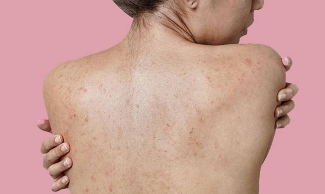 Back Acne: ব্যাকনে কী? এই সমস্যা থেকে মুক্তি পেতে রইল কিছু সেরা ঘরোয়া উপায়