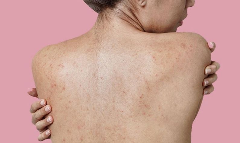 Back Acne: 'ব্যাকনে' কী? এই সমস্যা থেকে মুক্তি পেতে রইল কিছু সেরা ঘরোয়া উপায়