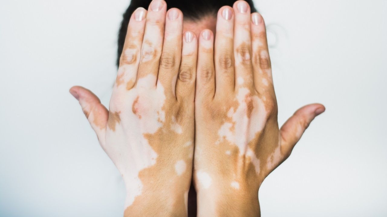 Vitiligo: শ্বেতীরোগ ছোঁয়াচে! সমাজে চিরাচরিত ভুল ধারণাগুলি এখনই বন্ধ করা দরকার