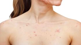 Breast Acne: স্তনেও দেখা দিতে পারে ব্রণর সমস্যা! জানুন এর পিছনে দায়ী কোন কারণগুলি Breast Acne: স্তনেও দেখা দিতে পারে ব্রণর সমস্যা! জানুন এর পিছনে দায়ী কোন কারণগুলি
