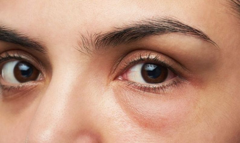 Eye Health: চোখের কি ক্লান্তি আর ফোলাভাব গ্রাস করছে ধীরে ধীরে? সমস্যা থেকে মুক্তি পেতে রইল জরুরি টিপস