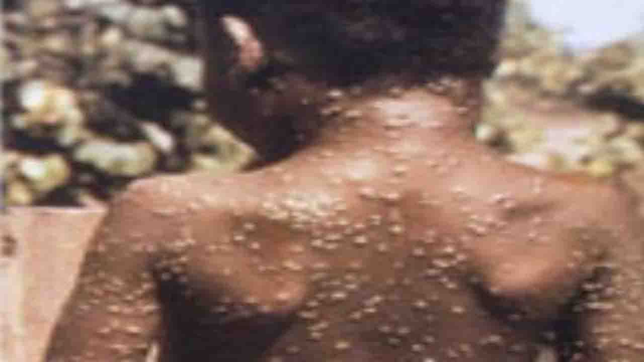 Monkeypox Outbreak: বিশ্বে ছড়াচ্ছে মাঙ্কি পক্স সংক্রমণ, করোনার মতোই হতে পারে ভয়াবহ
