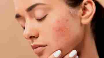 Acne Myths: ব্রণ নিয়ে অনেক ভুল ধারণা আমাদের মধ্যে প্রচারিত হয়, এক নজরে সেই সব ভুল ধারণাগুলো জেনে নিন...